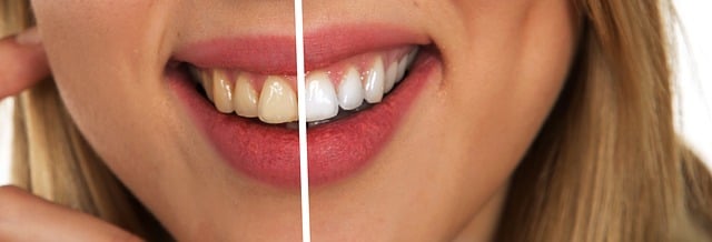 stav před a po vybělení zubů